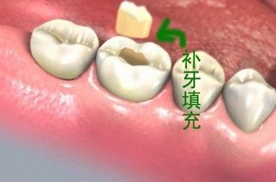 补牙材料如何选择